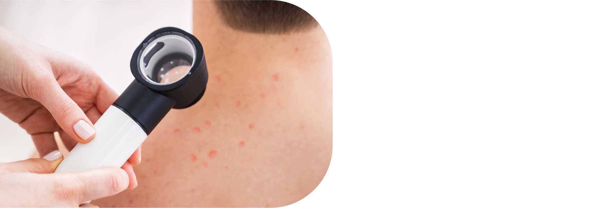 Acne care